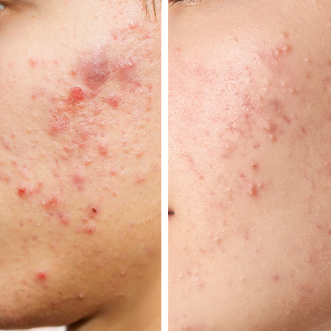 Blemish Spot Treatment